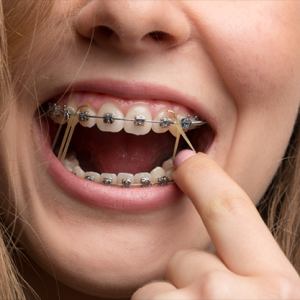 Orthodontics-Rubber-Bands